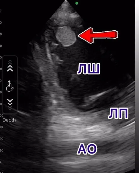 portable ultrasound scanner in suspected stroke diagnosis