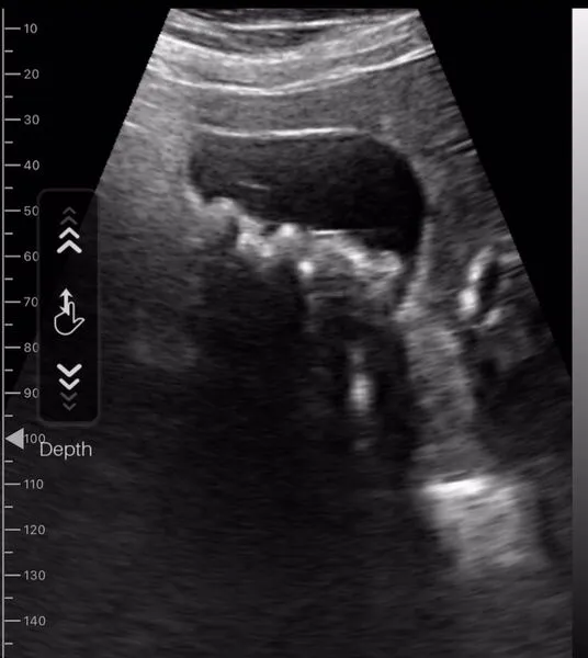 portable ultrasound gallbladder examination